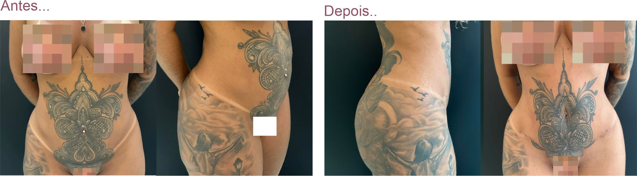 tatuagem e abdominoplastia